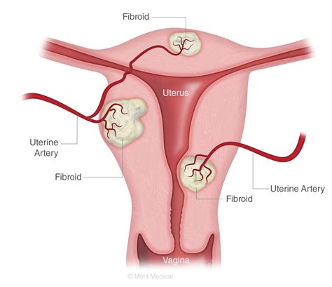 Uterine Fibroids - Savannah Vascular Institute