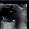 Diagnosis Ablatio Retina - Alomedika