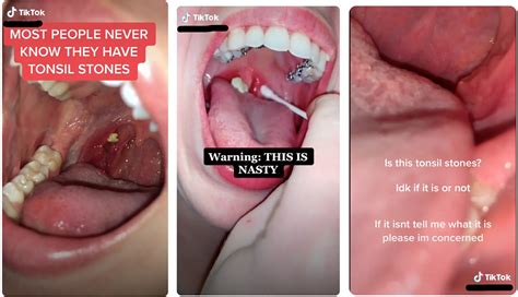 TikTok Tonsils - Anita Sulibhavi, Glenn Isaacson, 2024