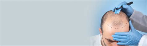 FUE Hair Transplant in South Delhi | DermoRita Skin Clinic