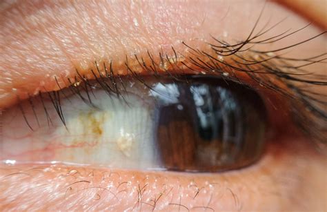 Bildergebnis für blepharitis ansteckend