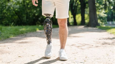 Above Knee Amputation Rehabilitation: Prosthetic Gait Training - Propel Physiotherapy