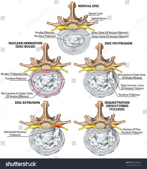 Bulging Disc Vs Herniated Disc Whats The Difference