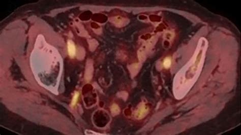 Bildgebung bei Riesenzellarteriitis - Rheumatologie - Universimed ...