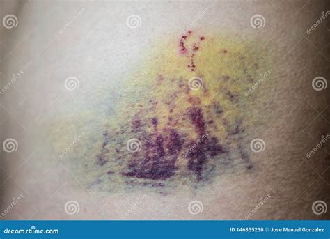 Closeup on a Bruise on Wounded Man Stomach Skin. Purple Hurt Veins ...