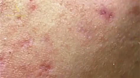 Image result for Worst Exploding Pimple