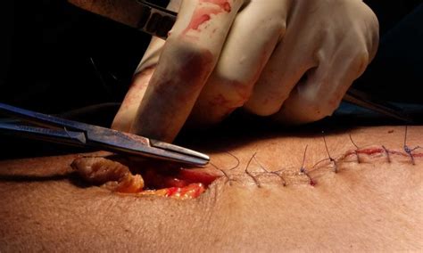 Image result for Simple Continuous Suture Removal