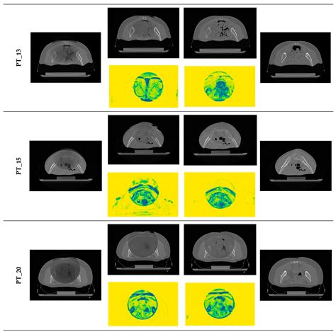 Unsupervised Deep Learning for Synthetic CT Generation from CBCT Images ...