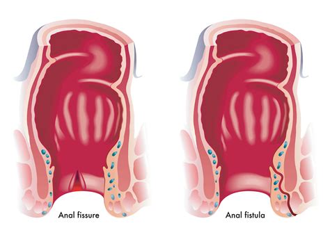 Anal Fissures