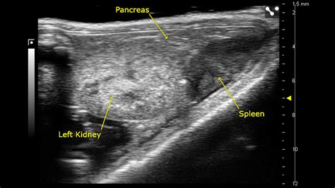 Left Kidney, Spleen and Pancreas | FUJIFILM VisualSonics