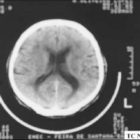 Image result for Normal Profile CT
