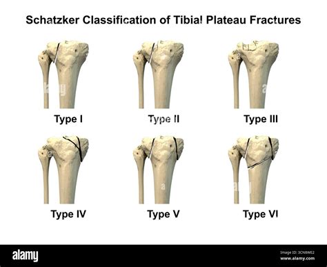 Illustration of the Schatzker classification of tibial plateau fractures, types I to VI, used to ...