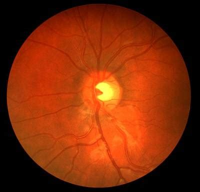 CHASE DB1 - Dataset Ninja