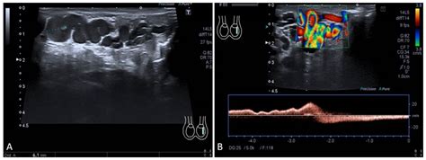 Embolization in Pediatric Patients: A Comprehensive Review of ...