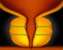 Image result for Urolift Recovery Process