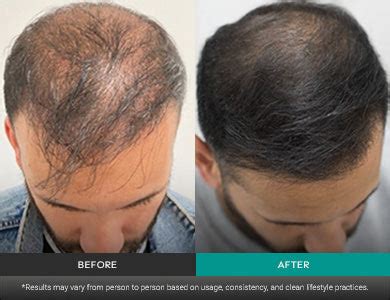 Intensive Hair Growth Serum for Fuller, Denser, Thicker Hair Growth ...