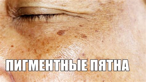Пигментные пятна на теле причины появления у женщин фото