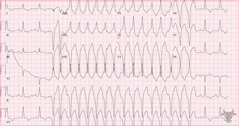 Hypertrophic Cardiomyopathy | ECG Stampede
