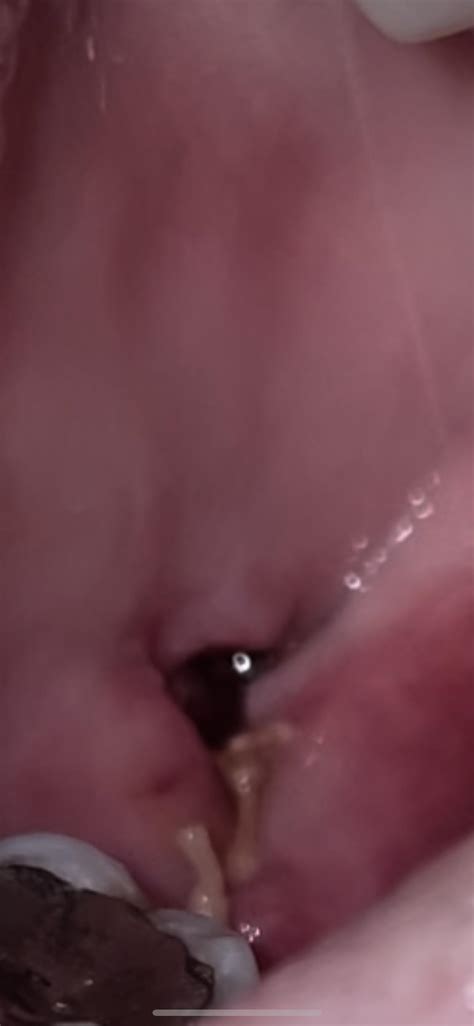 I have a bump inside of my tongue : r/askadentist