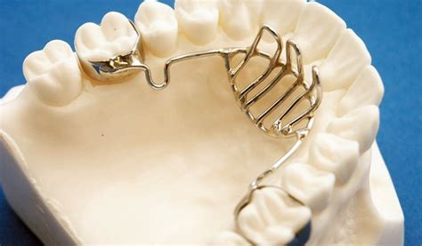 Habit Breaking Appliance | Treatments | TEETH CARE