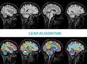 Huntington's disease setback for Roche shifts the research spotlight to ...