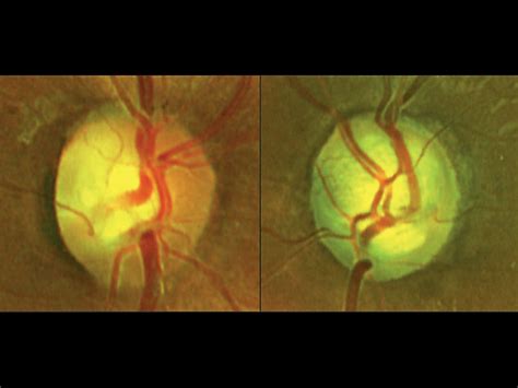 Young man loses sight in both eyes after drinking intoxicating drinks ...