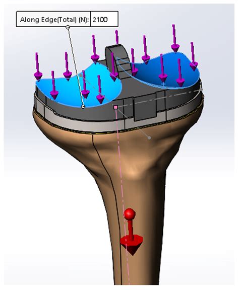 Tibial Stem Extension versus Standard Configuration in Total Knee ...