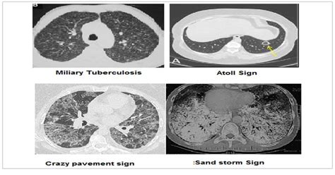 Commonly encountered chest/lung CT scan signs and their relevance