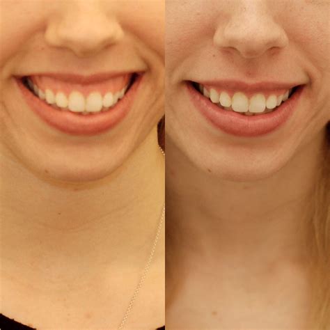 Пластика уздечки губ: комплексный подход к здоровью и эстетике вашей ...