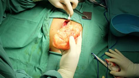 Lipoma Removal Procedure in Singapore | NC Tan Surgery | Dr Tan Ngian Chye