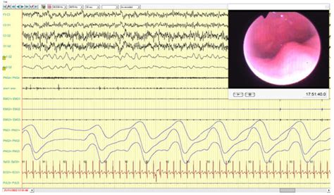 Proposal of a Full Digital Workflow for a Bite Fork to Assess ...