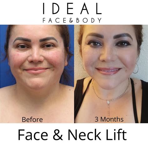 does laser lipo work? 7 Powerful Facts You Must Know 2025