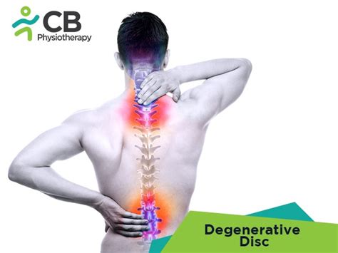 Best Treatment for Degenerative Disc Disease in Hyderabad | Book ...