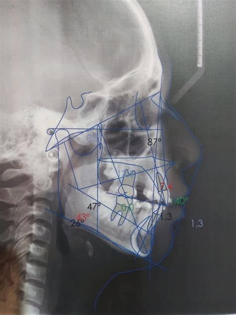 Image result for Tooth Extraction Side Profile