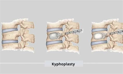 PCKP has less risk of cement leakage than UPKP in treatment of ...