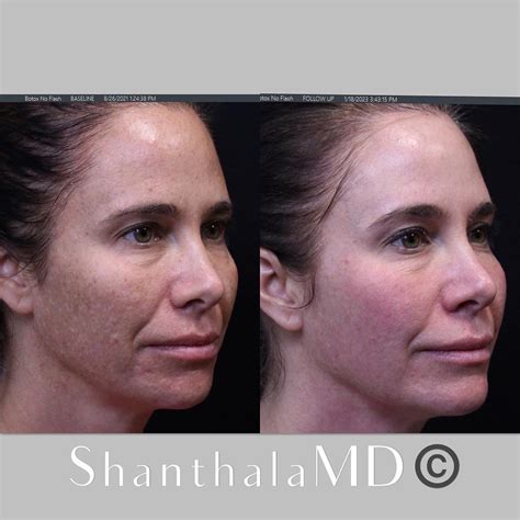 Fractional Nonablative Laser Skin Resurfacing - Boston