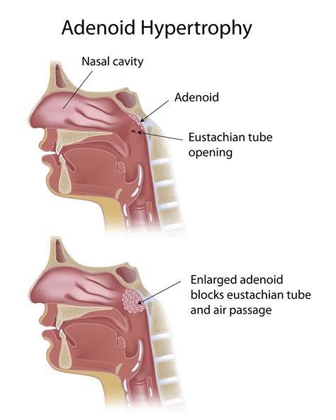 Adenoids Surgery