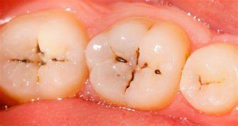 蛀牙从形成到失去牙齿要多久？ - 知乎