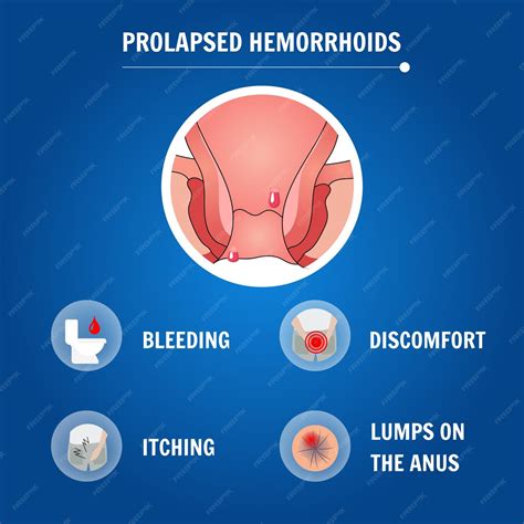 Premium Vector | Medical infographic prolapsed hemorrhoids