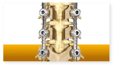 Laminectomy With Fusion