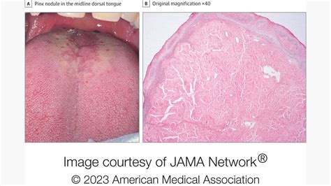 Big Bumps On Back Of Tongue : Bumps on the Back of Your Tongue? Here’s What You Need to Know ...