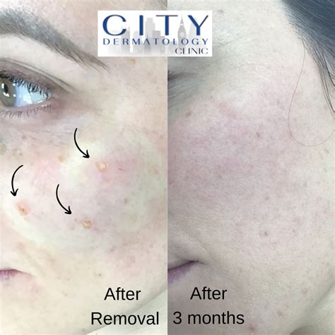 Before & After Photos Mole Removals