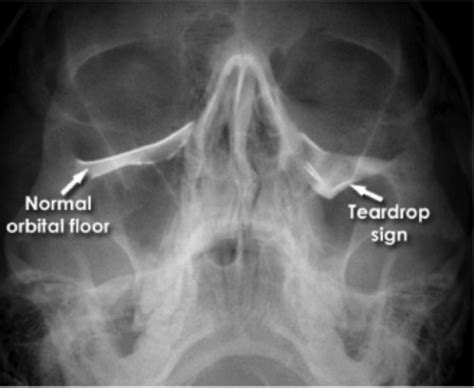 PARANASAL AIR SINUSES Flashcards | Quizlet