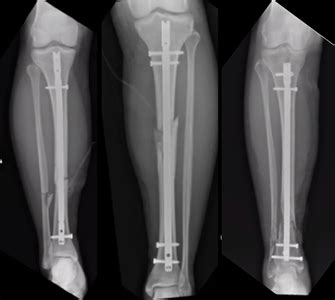 Tibial Shaft Fracture (Broken Lower Leg Bone) | Orthopaedic Trauma ...