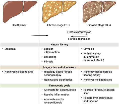 Found in translation—Fibrosis in metabolic dysfunction–associated steatohepatitis (MASH ...