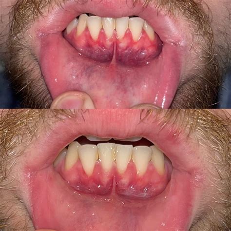 Image result for Bottom Teeth Calcium Buildup