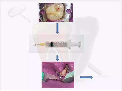 Image result for Direct Pulp Capping Vs RCT
