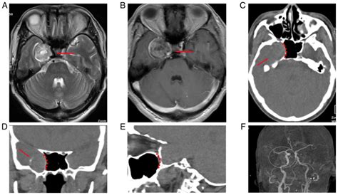 Middle Cranial Fossa