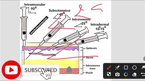 Angle of Injection 的图像结果