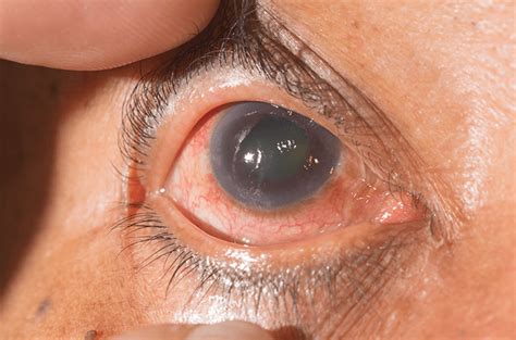 3 Cara Pengobatan Glaukoma